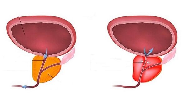 Healthy and inflamed prostatitis with prostatitis