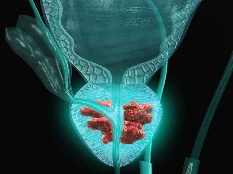 prostatitis