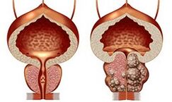 Healthy and unhealthy prostate